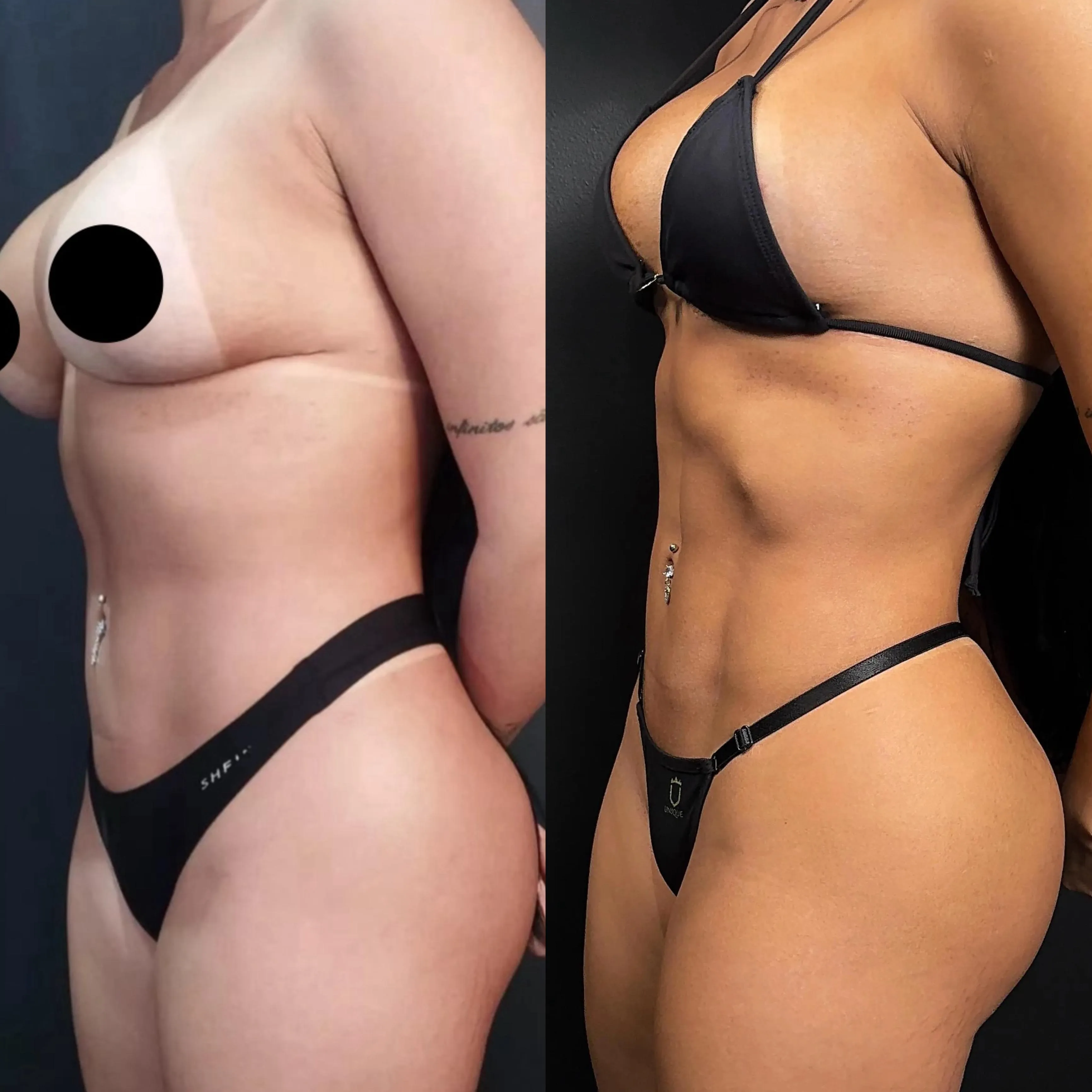 Lipoaspiração - Procedimento Estético