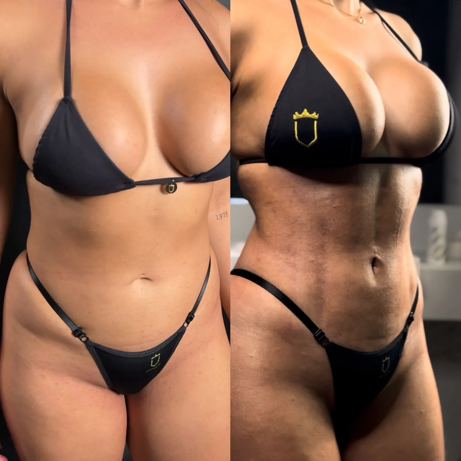 Lipoaspiração - Procedimento Estético