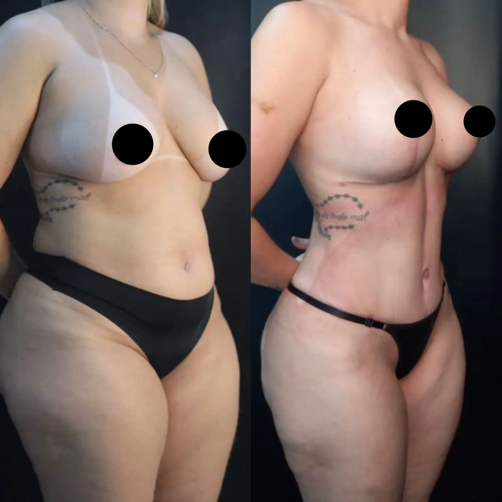 Mommy Makeover - Transformação Pós-Maternidade